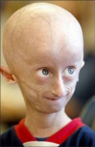 Create meme: hastalıklar, small head, progeria