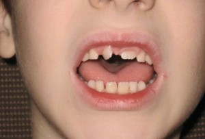 Создать мем: передние зубы у детей, детские передние зубы, молочные зубы