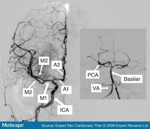Сегмент а1 пма. Сегмент а1 передней мозговой артерии схема. Сегменты средней мозговой артерии мрт. М1 м2 ветви средней мозговой артерии. ВСА артерия сегменты.