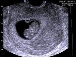 Create meme: ultrasound of 8 weeks of pregnancy, fetus at 8 weeks of pregnancy ultrasound, ultrasound at the 8th obstetric week