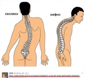 Создать мем: кифоз грудного отдела позвоночника, сколиоз кифоз грудного отдела, сколиоз кифоз