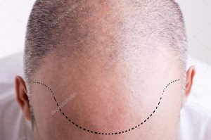 Создать мем: линия волос, hair transplantation, bald head