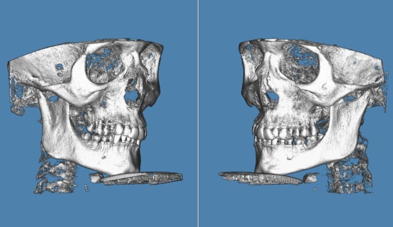 Создать мем: верхняя челюсть, кости лицевого черепа, челюсть нижняя