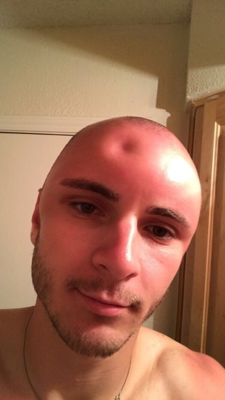 Create meme: dent on the head, a bad sunburn, Thank Marlowe shaved his head