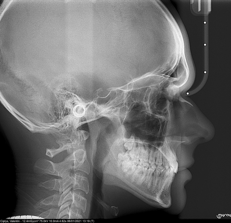 Создать мем: рентгенография костей носа, телерентгенография черепа, телерентгенограмма черепа (трг)