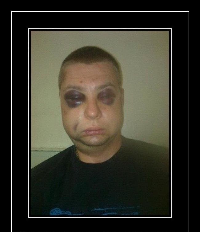 Create meme: with bruises, people , the guy with the black eye