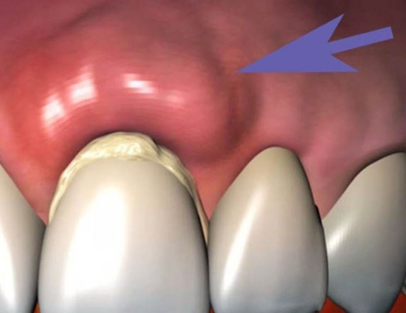 Create meme: periodontal abscess flux, periodontal abscess, gum inflammation