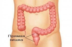 Создать мем: аппендицит, симптомы рака прямой кишки, прямая кишка