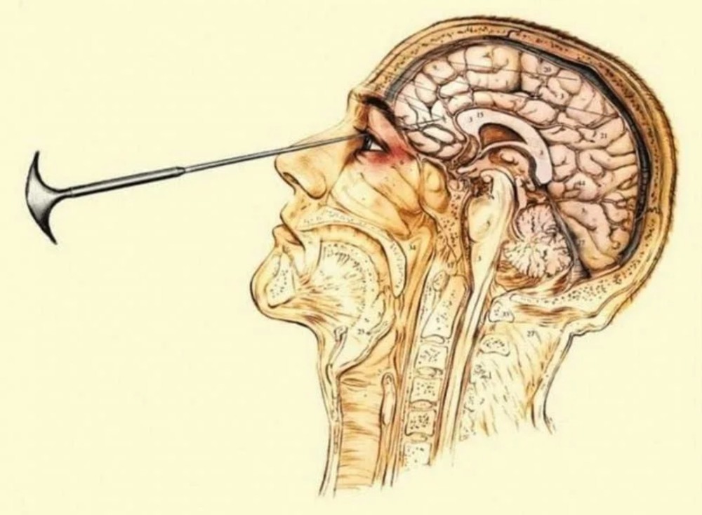 Создать мем: золотая эра лоботомии, трансорбитальная лоботомия, лоботомия последствия