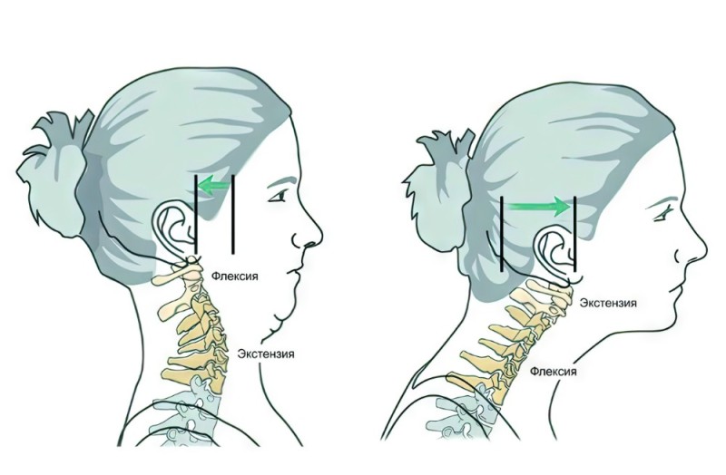 Create meme: osteochondrosis of the cervical spine, lordosis of the cervical spine, micro movements for the neck