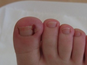 Create meme: fungus of the toenails in children, fungus of the toenails in children photos, ingrown nail on the big toe