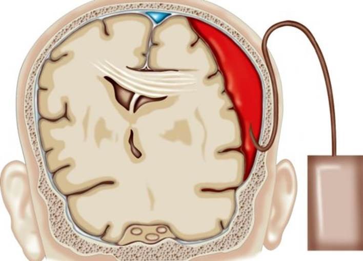 Create meme: subdural subcostal hematoma, subdural cerebral hemorrhage, traumatic subdural cerebral hemorrhage