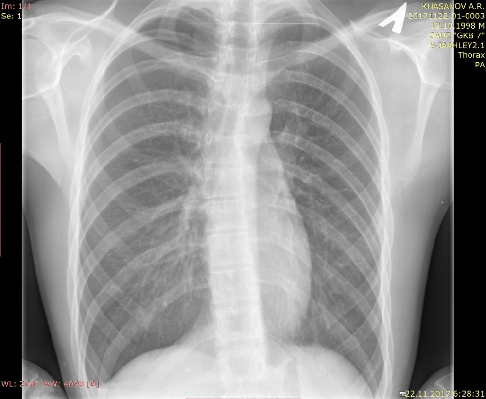 Create meme "x-rays of healthy lungs, a chest x-ray, lungs x-ray"...