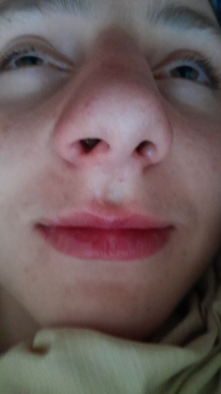 Create meme: lips , redness under the nose, rash on the nose