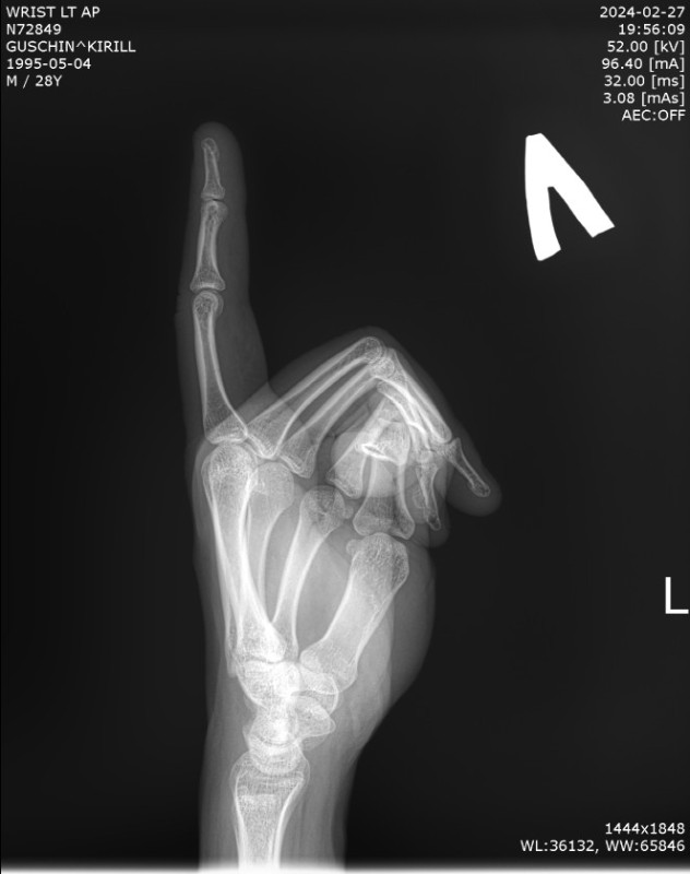 Create meme: body part, fractured finger snapshot, x-ray