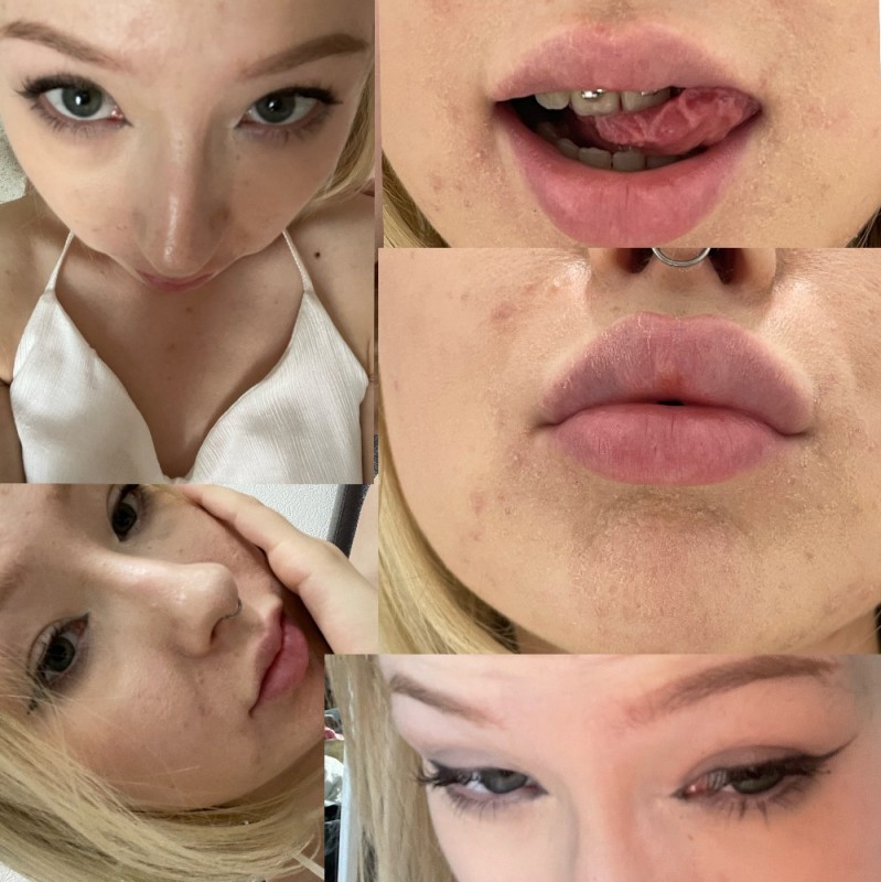 Create meme: hyaluronic acid lips, hyaluronic acid lips, lips with hyaluronic acid