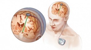 Create meme: deep brain stimulation in Parkinson's disease frame, glioma of the brain, brain tumor