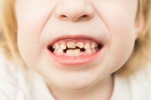 Create meme: teeth in children, milk teeth