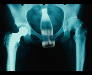 Create meme: x-rays of objects stuck, bottle in ass x-ray, x ray