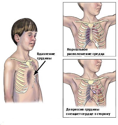 Create meme: chest, chest in children, funnel-shaped chest in a child