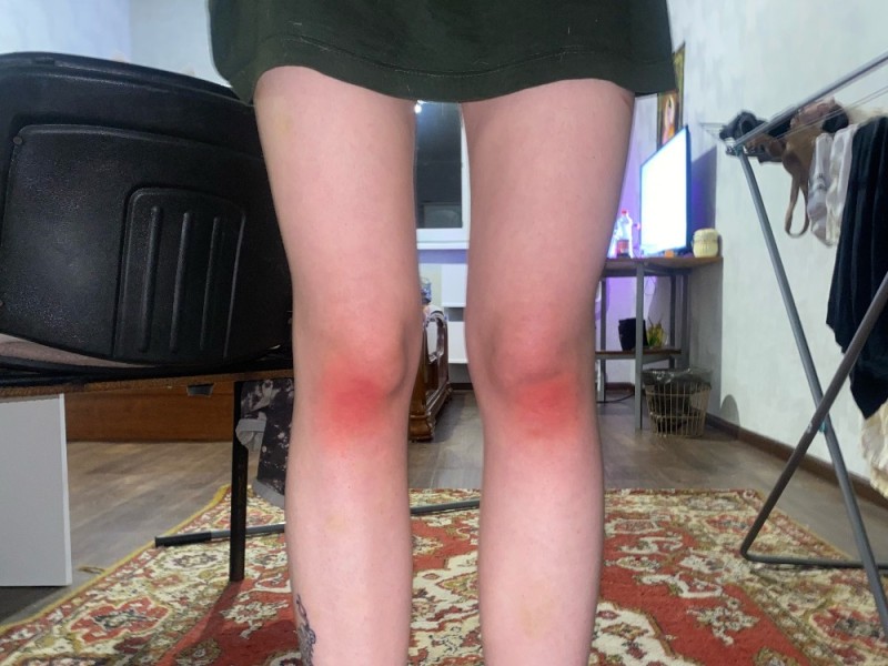 Create meme: redness of the legs, knee , my knee is swollen