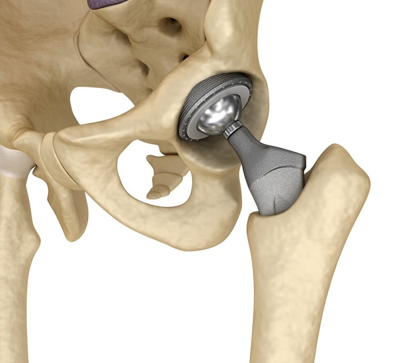 Create meme: hip replacement, hip joint prosthesis, hip replacement