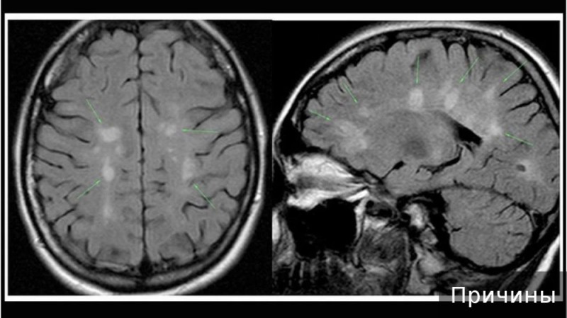 Create meme: the brain on MRI, multiple sclerosis on MRI, mri of the brain