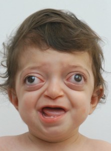 Create meme: facial symptoms of crouzon, of crouzon syndrome, face