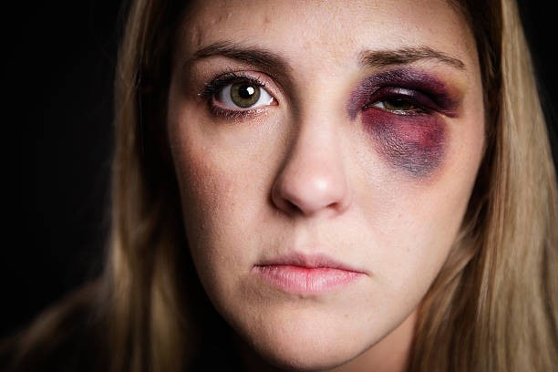 Create meme: a black eye, the girl with black eyes, a woman with bruises