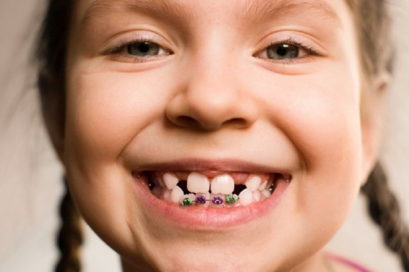 Create meme: baby braces, braces on teeth, smile braces