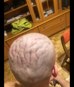 Create meme: scarring alopecia, hair, Part of the human body