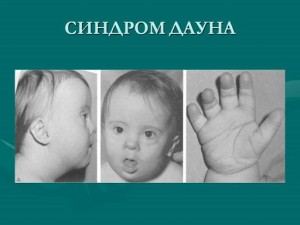 Создать мем: синдром дауна симптомы, синдром дауна это наследственное заболевание, признаки дауна у детей до 1