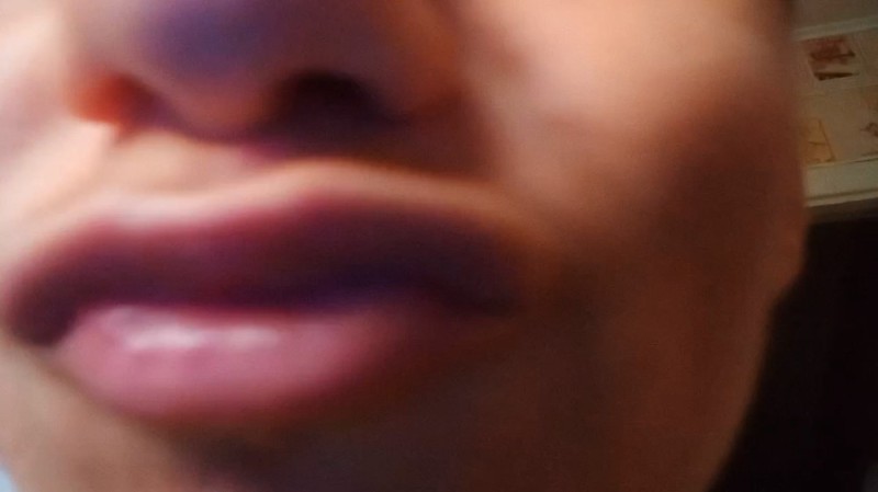 Create meme: swelling on the lip, beautiful lips , swollen lip