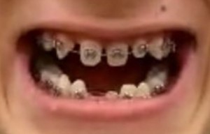 Create meme: teeth, bite, lil pump braces