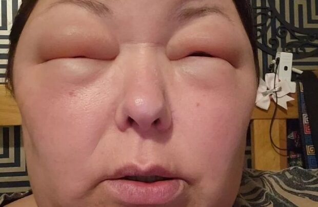 Create meme: swollen face, a person bitten by bees, swelling of the face