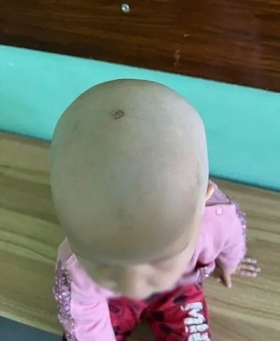 Create meme: traces on the skin, the bald head of a child, people 