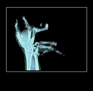 Создать мем: рентген сломанной руки, часть тела, сломанный палец
