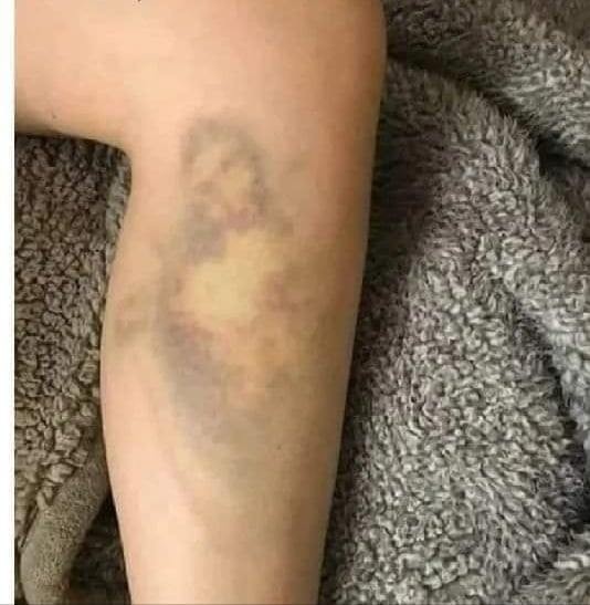 Create meme: a bruise on my arm, bruise on the body, bruises on the legs
