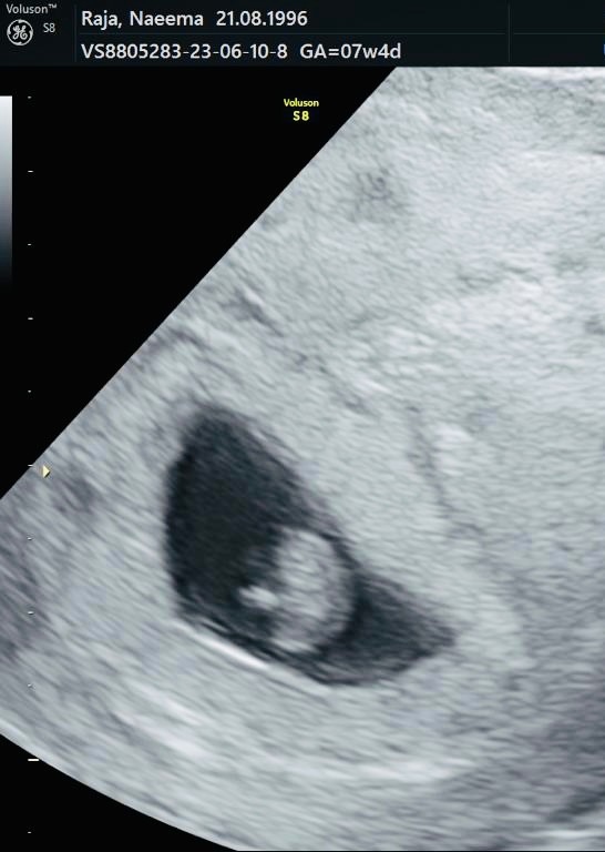 Create meme: fetus at 7 weeks of pregnancy ultrasound, embryo at 6 weeks of pregnancy ultrasound, ultrasound of 7 weeks of pregnancy