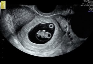 Create meme: fetal ultrasound, pregnancy ultrasound
