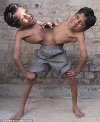 Создать мем: индийские сиамские близнецы шиванатх, разделение сиамских близнецов, первые сиамские близнецы