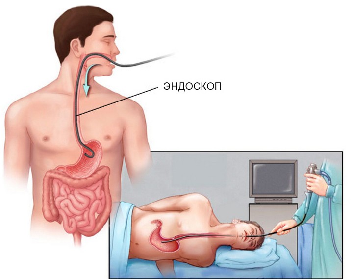 Create meme: Gastroscopy, gastroscopy (EGDS, fgds), fgds of the stomach