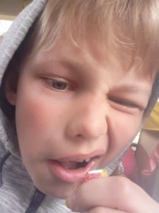 Создать мем: шишка от укуса мошки на глазу у ребенка, кислая конфета, лицо