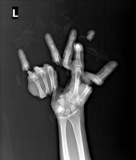 Создать мем: снимок руки, перелом пальцев кисти рентген, часть тела
