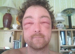 Create meme: swollen face, a bee sting in the eye, bees bitten face
