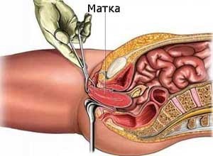 Создать мем: удаленная матка, эндоскопия матки, матка