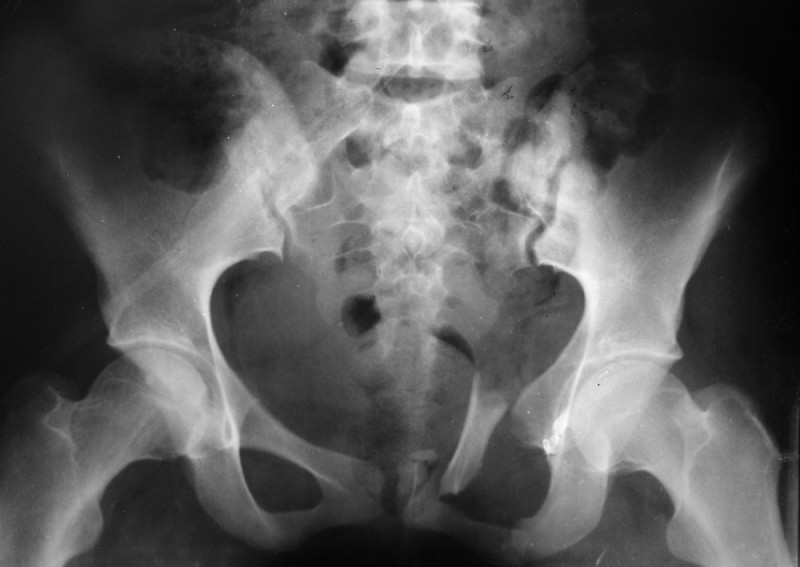 Create meme: vertical fracture of the sacrum X-ray, pelvic X-ray for sacroiliitis, sacrum X-ray