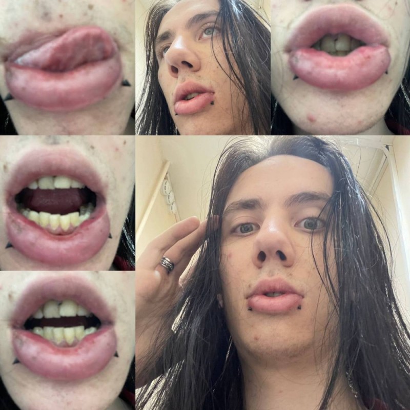 Create meme: people , for lip augmentation, lip plasty