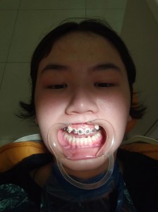 Создать мем: ортодонтия, вставные зубы, кривые зубы жесть