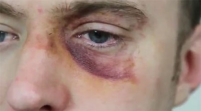 Create meme: black eyes, bruise from a blow, black eye 